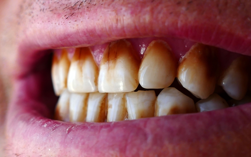 Teeth Stains from Coffee