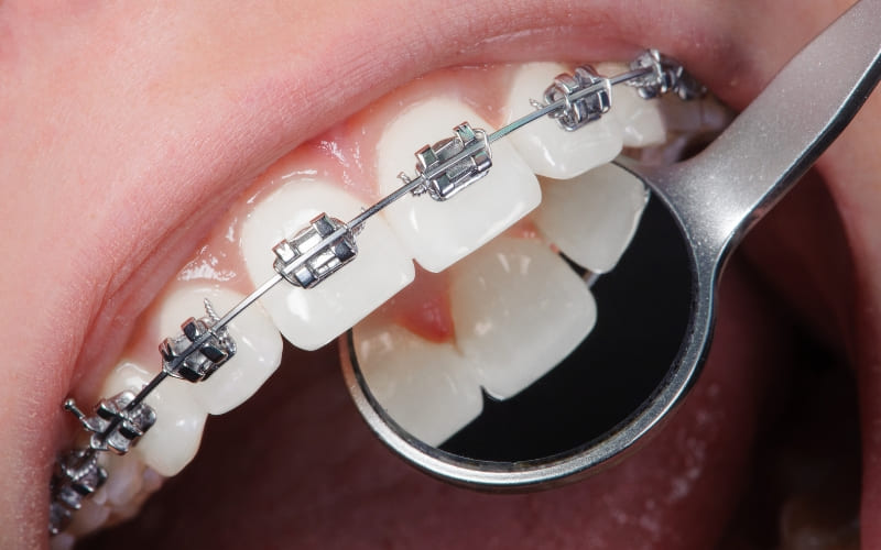 Braces Change the Shape of Your Face