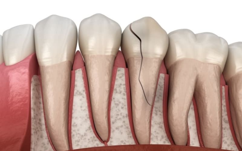 What Happens When a Cracked Tooth Goes Untreated?