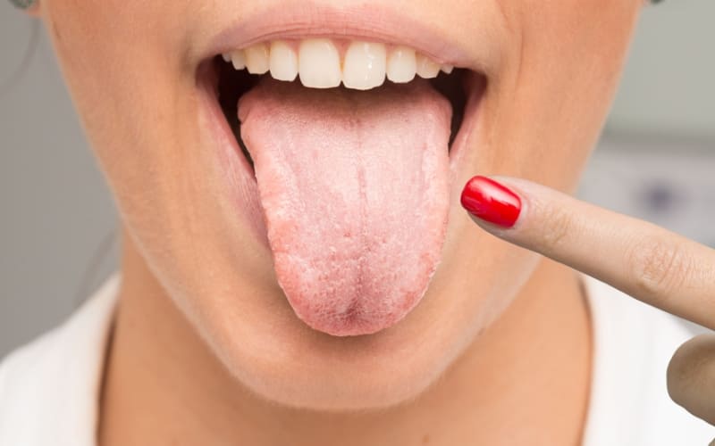 Tongue Indicate Health Problems